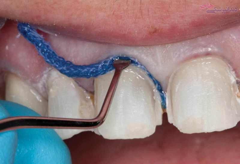 Dental Cord and gums